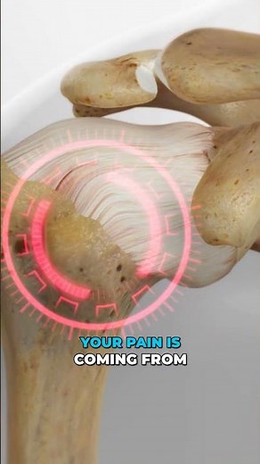 Shoulder Joint Injection Explained in 60 Seconds