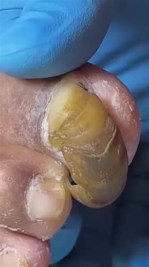 In-Depth Toenail Removal Experience That Will Shock You