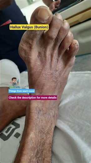 Bunion | Hallux Valgus | Deformity #anatomy #medical #medicalschoolcommunity #learning #hospital