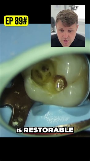 Tooth Decay Removal Restoring Your Smile Effectively