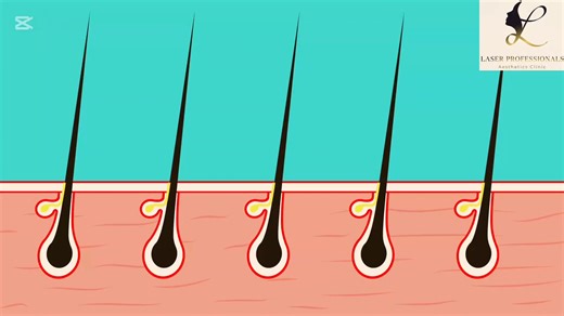 Discover How Laser Hair Removal Works for Smooth Skin