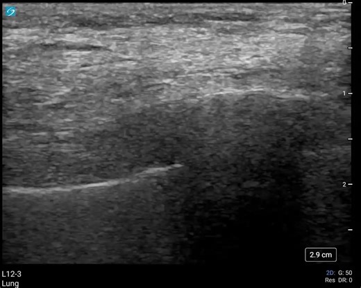 Thoracic Ultrasound of the Right Hemithorax