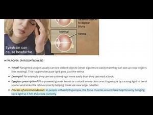 Optician Lesson 2: Refractive Errors and 6 Eye Conditions