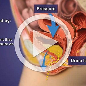 Prolapsed Bladder (Cystocele) Surgical Repair with a Vaginal Sling (TOT sling)