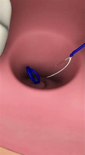 You’re not alone — feeling nervous about wisdom tooth removal is completely normal.