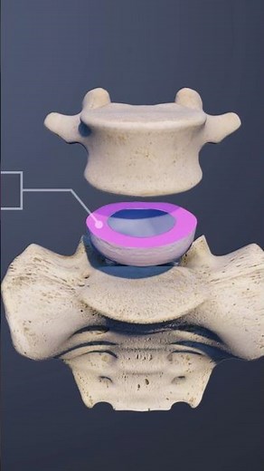 The Intervertebral Disc of the L5 S1 Spinal Motion Segment