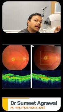 ARMD का Real Case | OCT Scan में Before & After Treatment कैसा दिखता है? | Dr Sumeet
