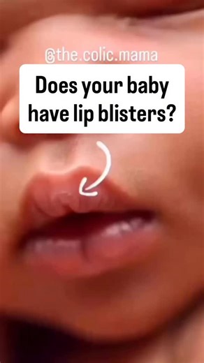 Sam Watts | Baby Colic Expert on Instagram: "Does your baby have lip blisters after feeding? 👶💋 Lip blisters are often a sign that your baby is gripping the breast or bottle with their lips instead of using their tongue — and that can point to oral dysfunction caused by ties or muscular tension. This can lead to compensatory feeding behaviours that cause frustration, pain, and poor feeding outcomes for both of you. 🚨 Other signs of oral dysfunction include: • Gulping, choking, or gagging duri