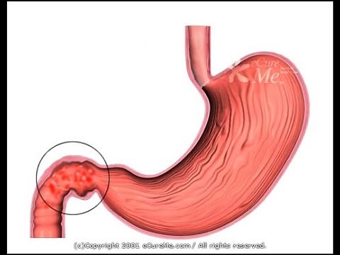 DUODENITIS (INFLAMACIÓN DEL DUODENO)