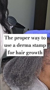 How to Use a Derma Stamp for Hair Growth- Houston Hair Restoration