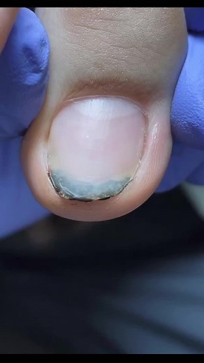 Dirty toenail cleaning #fypシ #fyp #ingrowntoenail #pedicure