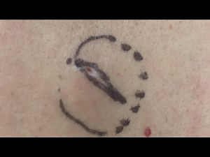 Dr. Pimple Popper Performs A Cyst Excision