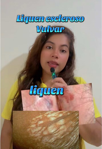 Liquen Escleroso Vulvar: Síntomas y Tratamiento