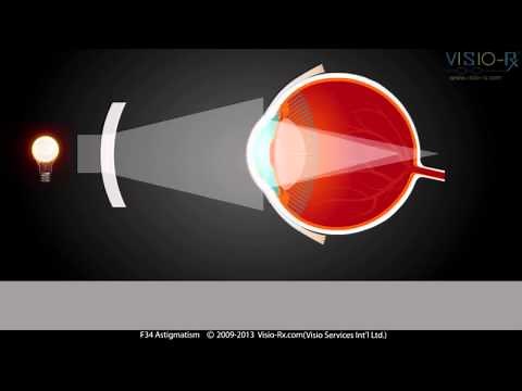 L'astigmatisme expliqué