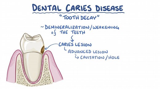 Video: Tooth decay and cavities - Video Explanation! | Osmosis | Osmosis