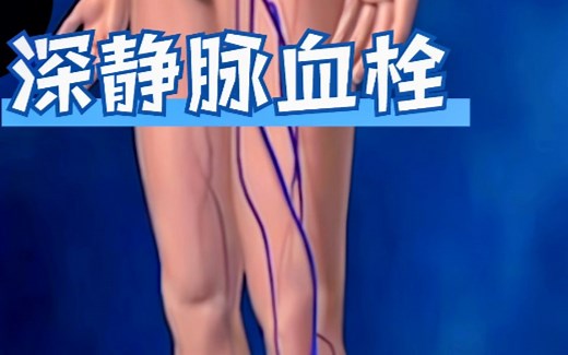 深静脉血栓Deep Vein Thrombosis (DVT)