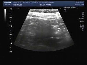 Ultrasound Video showing normal Appendix in a child of about 6 years.