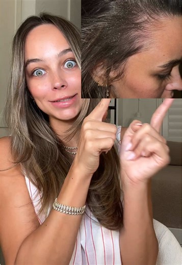 Winter Hair Care Routine for Scalp Psoriasis