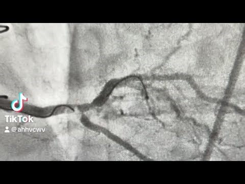 Tips & Tricks to wire a complex side branch ostial lesion!