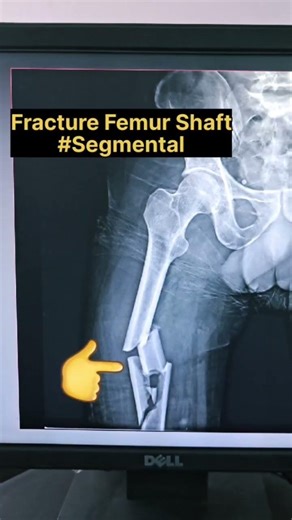 Femur Bone Fracture X-ray #radiographerusn