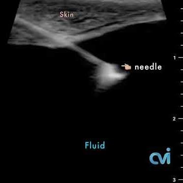 Hydrocele aspiration and sclerotherapy Los Angeles