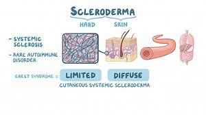 Video: Scleroderma - Video Explanation! | Osmosis | Osmosis