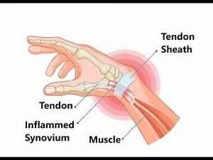 Tenosynovial Crepitus ; Definition, Meaning, Causes, Symptoms, Treatment