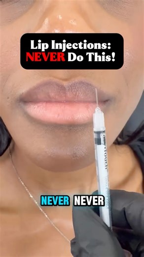 Samara, FNP-BC | Connecticut Medical Spa on Instagram: "Lip Injections 101: NEVER Do This... 🙅‍♀️ ❌ Trace the border ❌ Follow an injection map (e.g. v1, v2, v3, v4...) ❌ Use thick filler in soft lips ❌ Use the same type of filler for all lips ❌ Let a patient choose filler by name or brand ❌ Inject a full syringe just because a patient asked for it ❌ INJECT DIFFERENT PATIENTS THE SAME WAY #lipinjections #aestheticinjector #injectortraining #injectoreducation"
