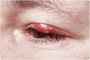 Blepharitis Types and Causes