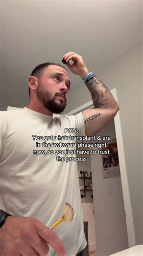Hair Transplant Awkward Phase: What to Expect and How to Trust the Process