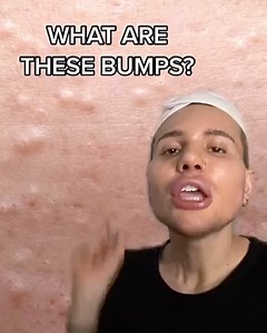 Matt Randon 🧩 on Instagram: "CLOSED COMEDONE AND HOW TO GET RID OF THEM!😱🌋 (follow me for more acne tips!🥰) - Closed comedones are really common during the tween and teen years, as the skin's sebaceous glands (also known as oil glands) ramp up production. 3﻿ With all that excess oil, comedones are more likely to form. Not only that, but certain products that you put on your skin might be contributing to these blemishes. #acnepositivity #acneproblems #acné #acneskincare #acnescars #pimplepop