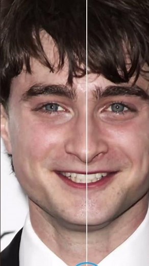 Eye Misalignment (BVD) ➡️ Poor depth & spatial perception ➡️ Poor coordination ➡️ Dyspraxia (Clumsin