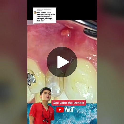 Reply to @erickapineda090 FISTULA (Tooth abscess) #docjohnthedentist #EDUWOW #healthtokph #learnontiktok #backtotiktokskwela