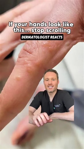 Tiny, itchy bumps on your hands? 😵‍💫 If you’re getting small fluid-filled blisters on your palms or fingers that itch like crazy, this may be dyshidrotic eczema — not just dry skin. Common triggers I see 👇 • Stress • Heat & sweat • Frequent handwashing • Cleaning & dishwashing • Jewelry (nickel) 💡 My overnight hand fix: Thick moisturizer cotton gloves before bed = better barrier, less itching. 👇 Want my full routine? Comment “dyshidrotic eczema” and I’ll send you my full list of eczema tips