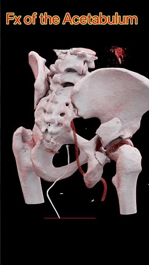 Fracture Of Acetabulum #fracture #acetabulum #ctpelvis #radiolog #bonefractures #shorts #aiims