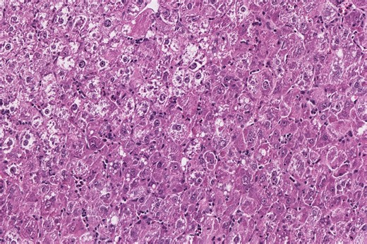 A New Mouse Model of Virus-Driven Liver Cancer May Open the Door to Better Diagnosis and Treatments | Newswise