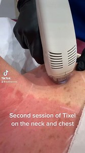 Second session of Tixel on the neck and chest. We would always recommend a course of three to achieve optimal results. . Tixel helps with fine lines, rejuvenation, acne scars and pigmentation. . If this a treatment that you might be interested in don’t hesitate to drop us a DM or give us a call on 01905795028. . | Outline Skincare Clinic