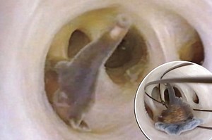 Shocking video reveals squirming worms invaded unaware man’s abdomen