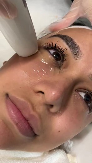 Treating under eyes and the jawline wuth HiFu ✨ #hifu #skincareroutine #skinclinic #facial #facialtreatment #skincaretips #skincare