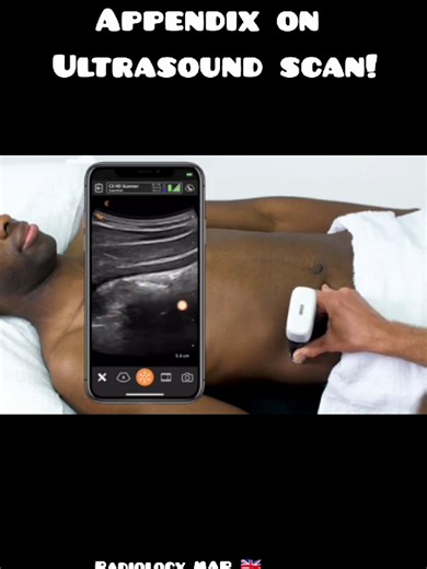 #creatorsearchinsights How find out appendix on ultrasound scan explained!! #ultrasoundvedios #howfindapoendixonultrasoundscan #ultrasoundtechnologists #radiologymap