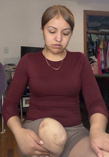Amputee Prosthetic Hair Journey: From Doubt to Confidence