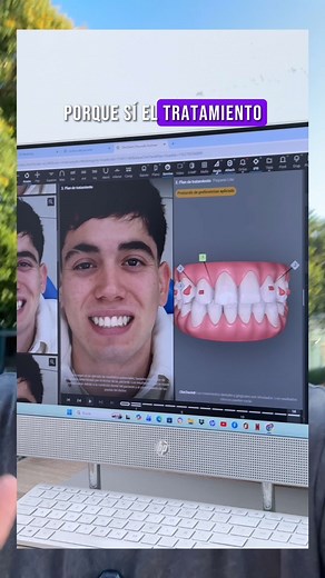 Transforma tu sonrisa: tecnología Invisaling en Chile