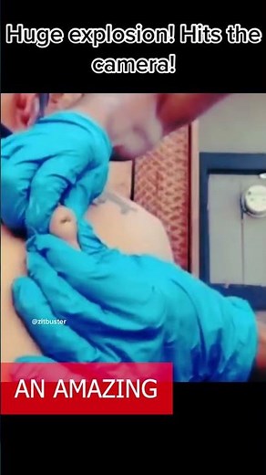 pimple popping 2022 new videos// blackhead and whitehead removal//dr pimple popper #3454FFG
