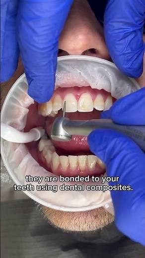 Removing Invisalign attachment #invisalign #drillingteeth #teeth #invisalignsmile #invisalignbraces