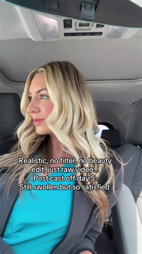 Some swelling but I am rocking it ! Don’t let people scare you ! | Getting My Cast Off