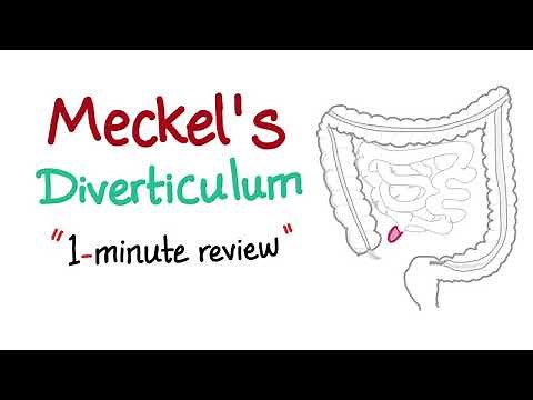 Meckel's Diverticulum (1-minute review)