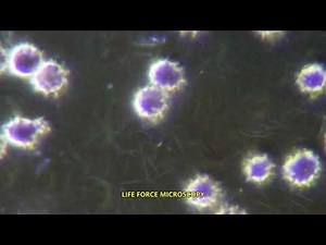 BLOOD TEST: FIBRIN SPICULES AND BLOOD CLOTTING IN LIVE BLOOD