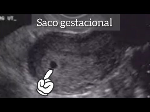 6 WEEKS PREGNANT I WENT TO HAVE A VAGINAL ULTRASOUND DONE, WE ONLY SAW THE GESTATIONAL SAC