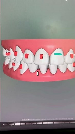 Did you know that Invisalign uses attachments? This is how it makes the process quicker + easier👆🏼😁
