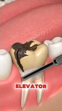 This is how dentists pull a tooth that's stuck deep inside your jaw #tooth #teeth #dentist #shorts